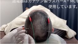 施灸
